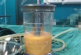 范县360度水动力吸脂费用多少钱？