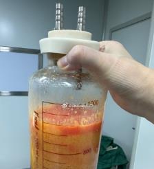 范县水动力吸脂手术要做多久？